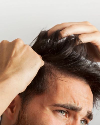 ¿Qué es la alopecia?