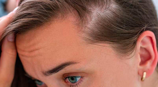 Alopecia Androgénética Femenina