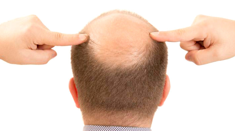 ¿Cómo afecta la herencia genética en la calvicie masculina?