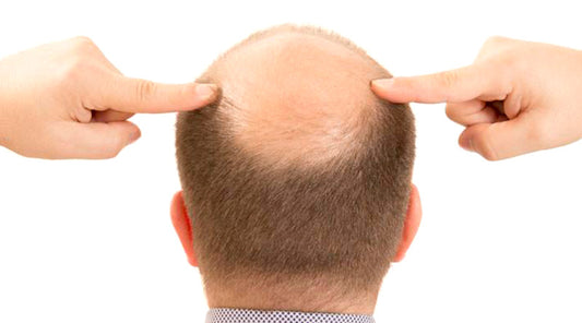¿Cómo afecta la herencia genética en la calvicie masculina?