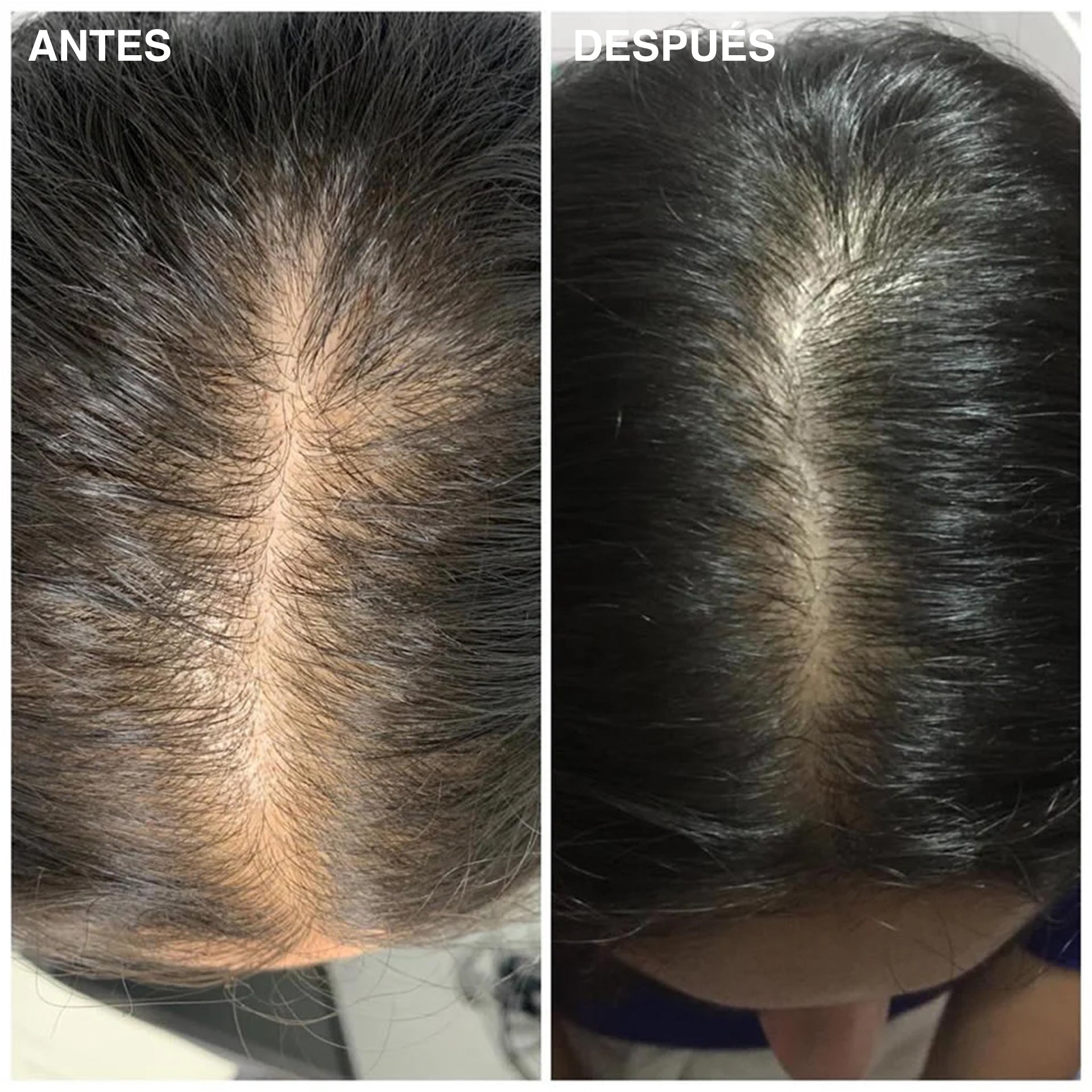 Tratamiento Intensivo Anticaída y Mayor Volumen