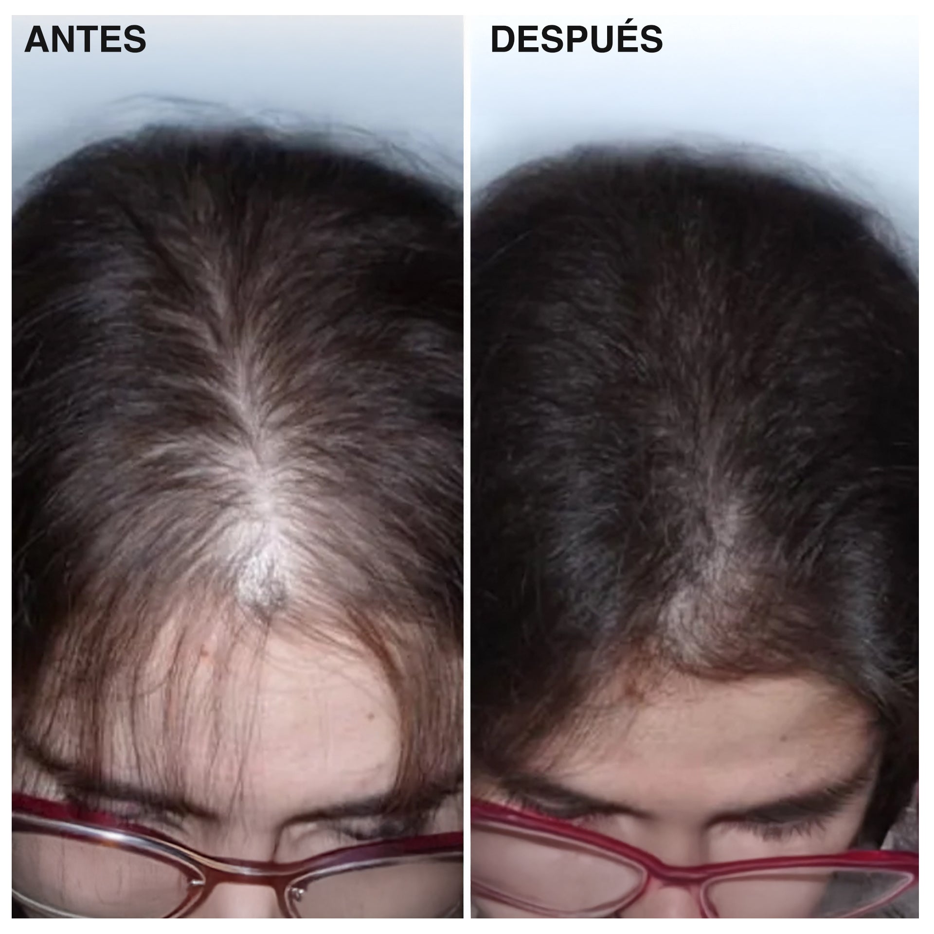 Tratamiento Intensivo Anticaída y Mayor Volumen