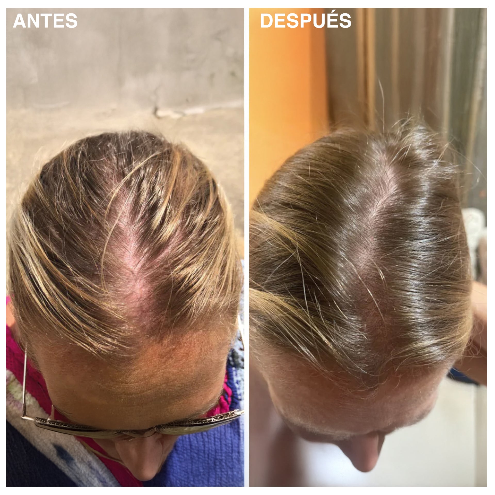 Tratamiento Intensivo Anticaída y Mayor Volumen
