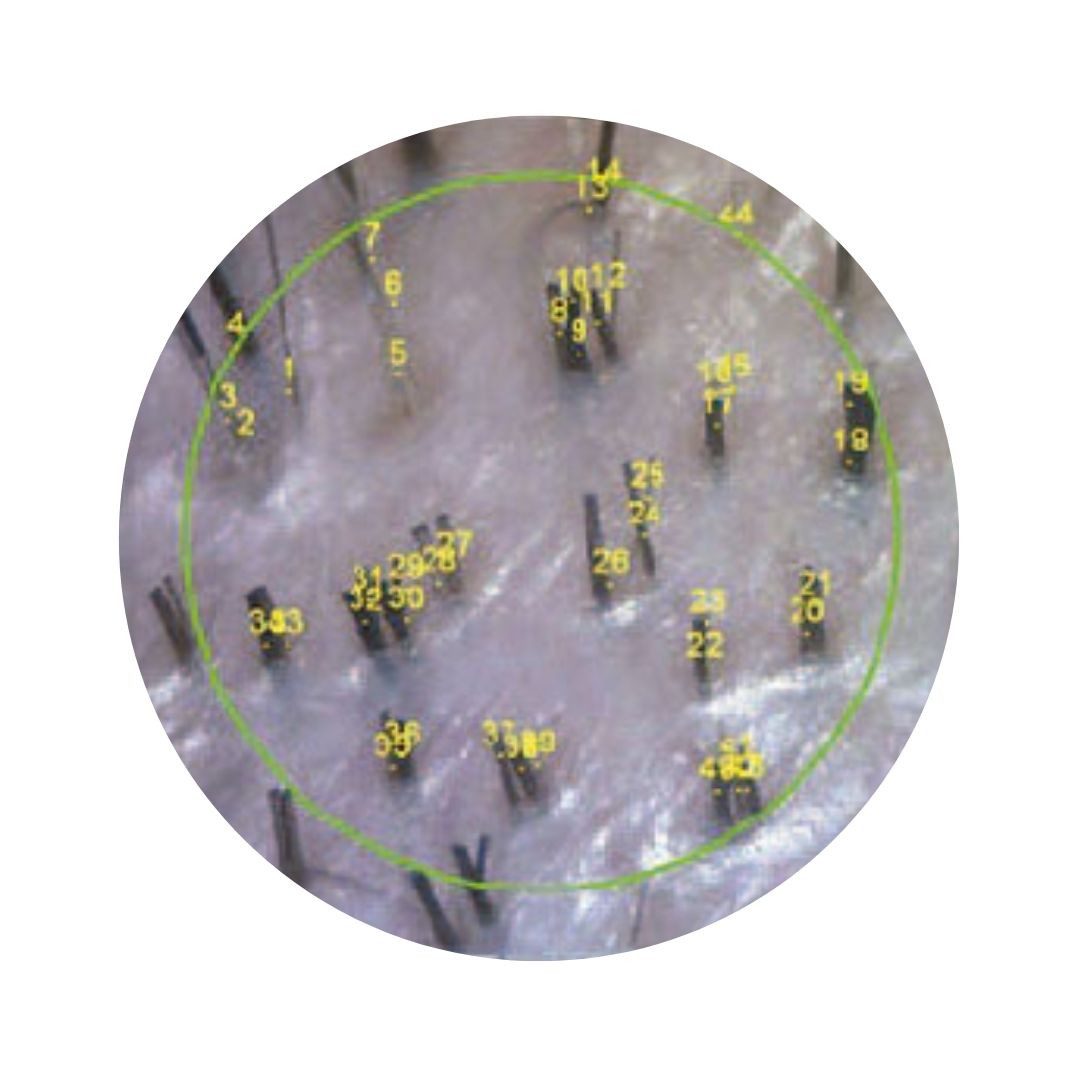 Imagen de cómo afecta el anargy al cuero cabelludo, incrementando el número de cabellos que crecen.